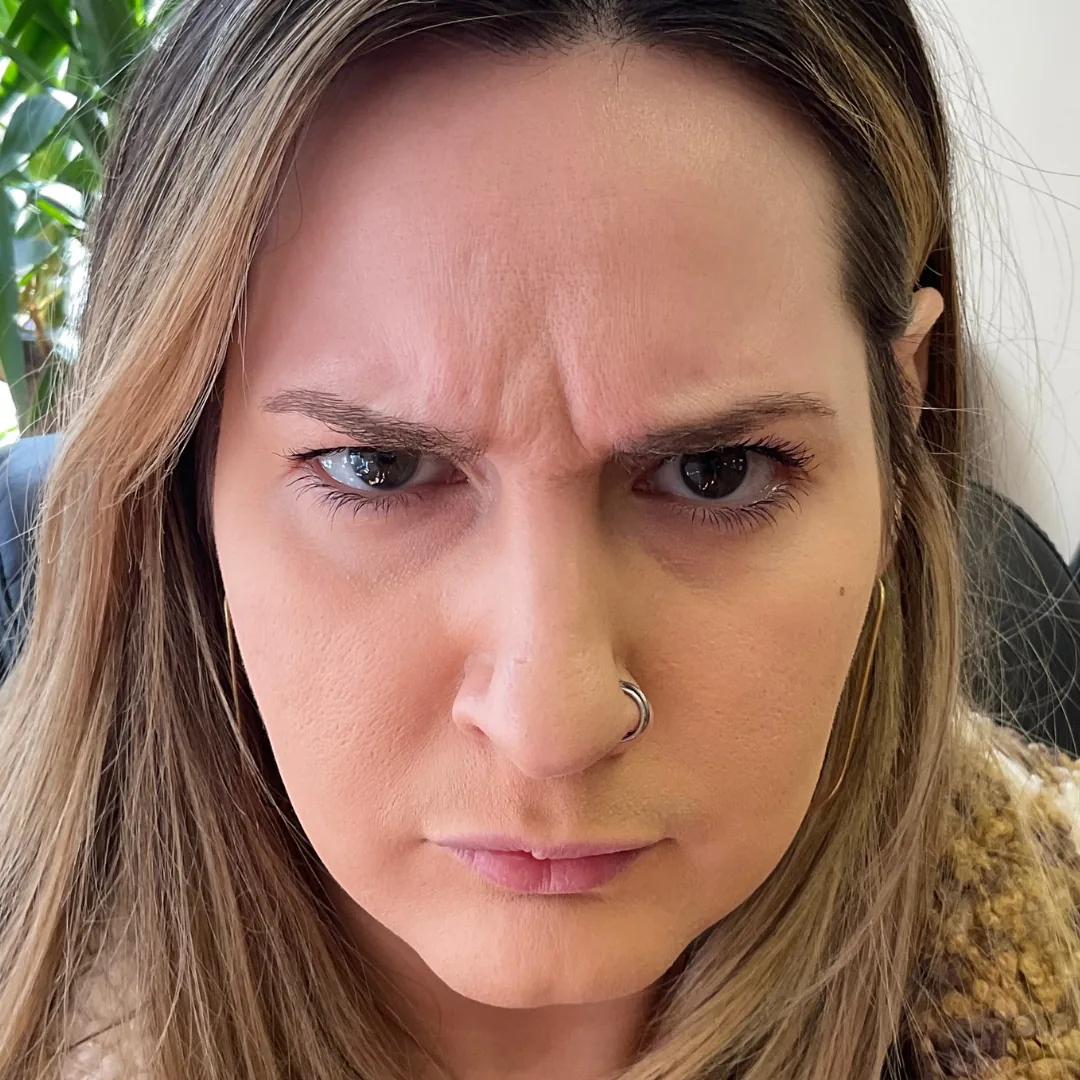 Before Botox treatment showing forehead and expression lines