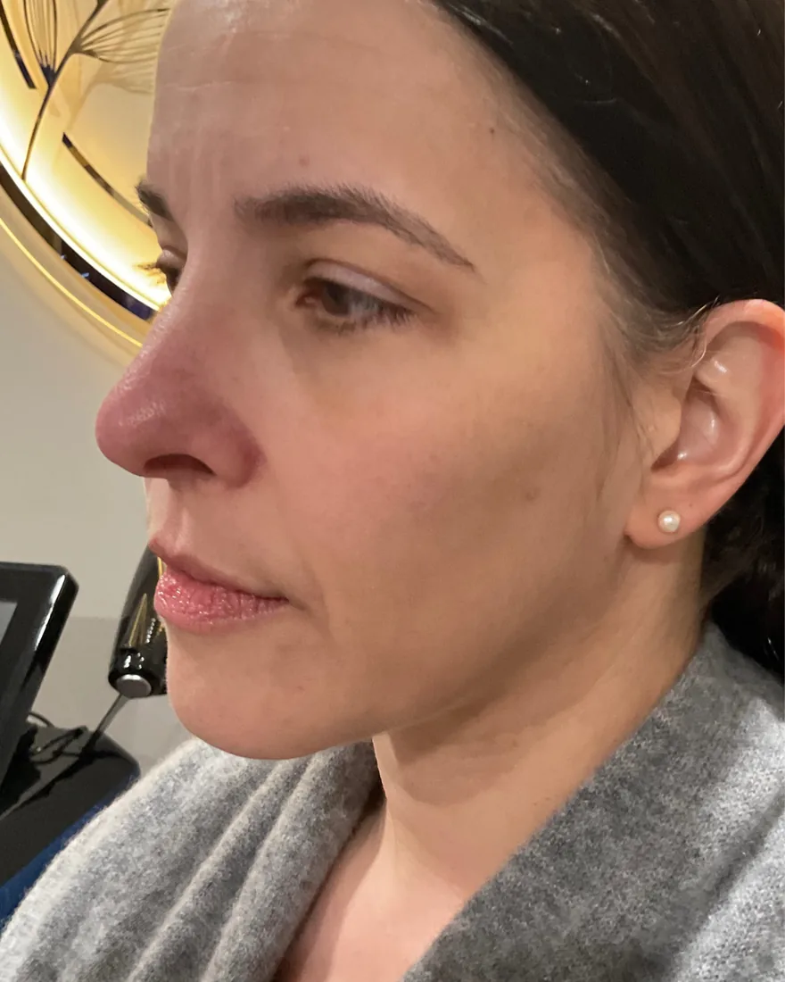 Before cheek filler treatment showing loss of facial volume