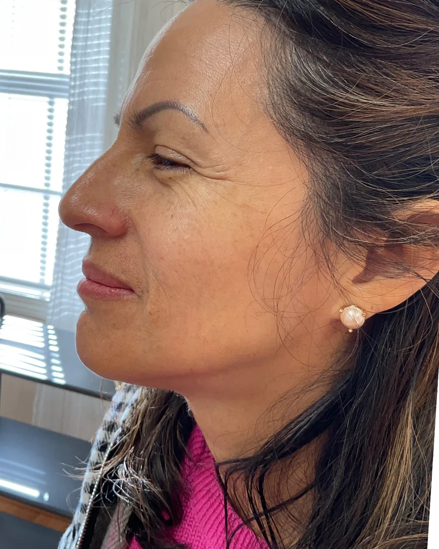 After VI Peel treatment with clearer brighter skin