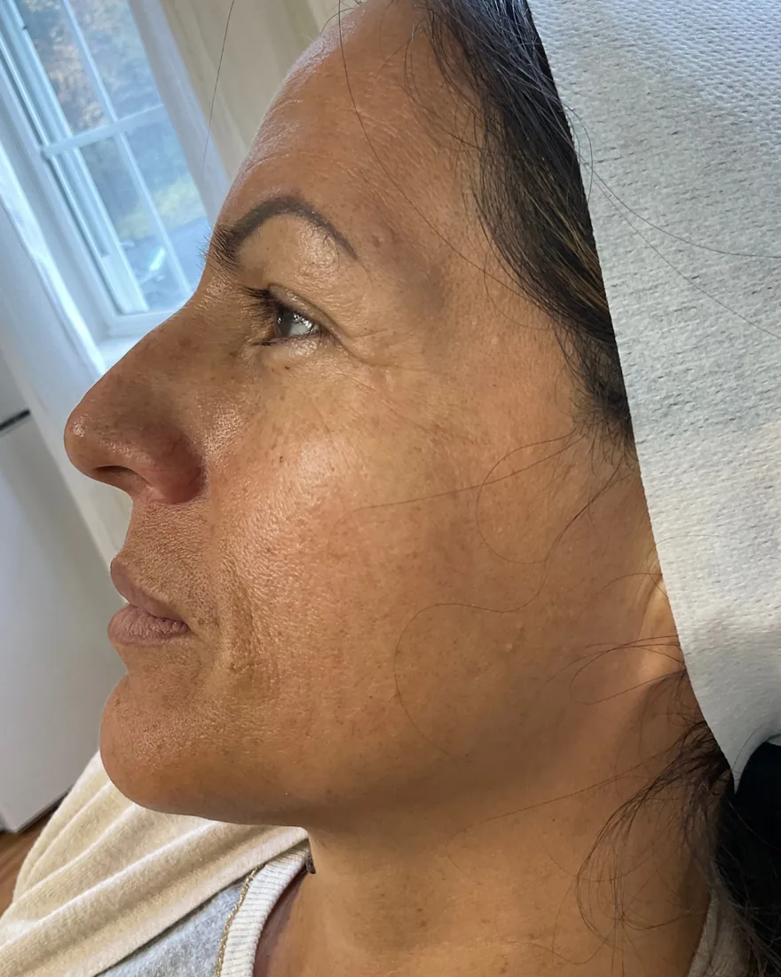 Before VI Peel treatment showing discoloration and uneven skin tone